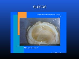 sulcos
v o l t a r a v a n ç a ri n í c i o
13/9/2005
Menisco medial
Superfície articular com sulcos
 