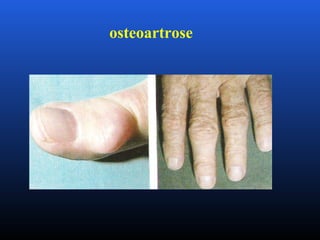 osteoartrose
 