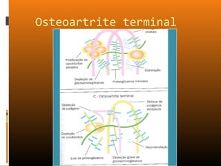 Osteoartrite terminal
 