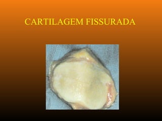 CARTILAGEM FISSURADA
 