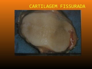 CARTILAGEM FISSURADA
 