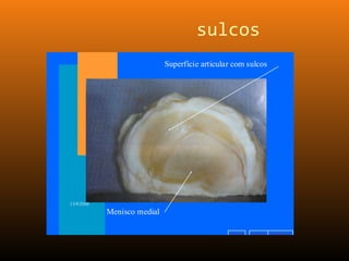 sulcos
v o l t a r a v a n ç a ri n í c i o
13/9/2005
Menisco medial
Superfície articular com sulcos
 