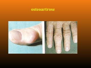 osteoartrose
 