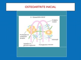OSTEOARTRITE INICIAL
 