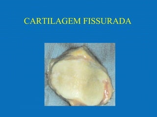 CARTILAGEM FISSURADA
 