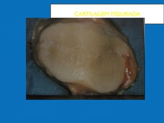 CARTILAGEM FISSURADA
 