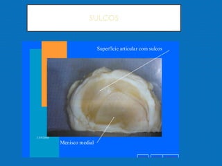 SULCOS
v o l t a r a v a n ç a ri n í c i o
13/9/2005
Menisco medial
Superfície articular com sulcos
 