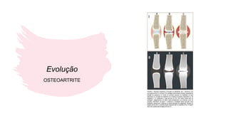Evolução
OSTEOARTRITE
 