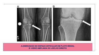 A-DIMINUIÇÃO DO ESPAÇO ARTICULAR EM PLATÔ MEDIAL
B -VISÃO AMPLIADA DO JOELHO DIREITO
 