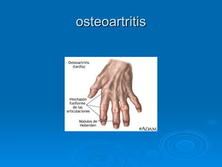 osteoartritis 