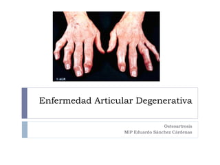 Enfermedad Articular Degenerativa Osteoartrosis MIP Eduardo Sánchez Cárdenas 