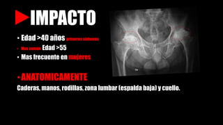 IMPACTO
• Edad >40 años primeros síntomas
• Mas común Edad >55
• Mas frecuente en mujeres
•ANATOMICAMENTE
Caderas, manos, rodillas, zona lumbar (espalda baja) y cuello.
 