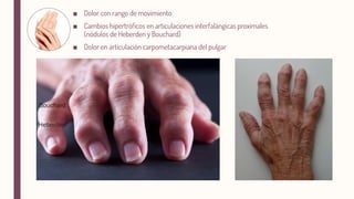 ■
■
■
Heberden
Bouchard
 