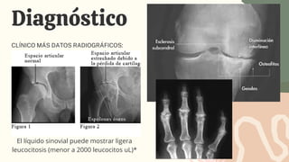 Diagnóstico
CLÍNICO MÁS DATOS RADIOGRÁFICOS:
El líquido sinovial puede mostrar ligera
leucocitosis (menor a 2000 leucocito...