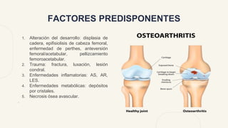 FACTORES PREDISPONENTES
1. Alteración del desarrollo: displasia de
cadera, epifisiolisis de cabeza femoral,
enfermedad de perthes, anteversión
femoral/acetabular, pellizcamiento
femoroacetabular.
2. Trauma: fractura, luxación, lesión
condral.
3. Enfermedades inflamatorias: AS, AR,
LES.
4. Enfermedades metabólicas: depósitos
por cristales.
5. Necrosis ósea avascular.
.
 