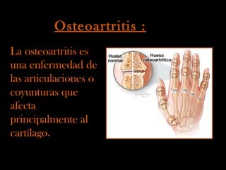 Osteoartritis :   La osteoartritis es una enfermedad de las articulaciones o coyunturas que afecta principalmente al cartílago.  