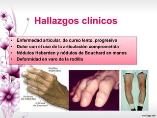 Hallazgos clínicos
• Enfermedad articular, de curso lento, progresivo
• Dolor con el uso de la articulación comprometida
• Nódulos Heberden y nódulos de Bouchard en manos
• Deformidad en varo de la rodilla
 