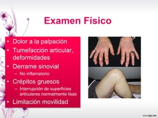 Examen Físico
• Dolor a la palpación
• Tumefacción articular,
deformidades
• Derrame sinovial
– No inflamatorio
• Crépitos gruesos
– Interrupción de superficies
articulares normalmente lisas
• Limitación movilidad
 