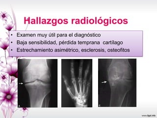 Hallazgos radiológicos
• Examen muy útil para el diagnóstico
• Baja sensibilidad, pérdida temprana cartílago
• Estrechamiento asimétrico, esclerosis, osteofitos
 