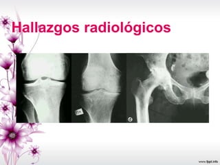 Hallazgos radiológicos
 