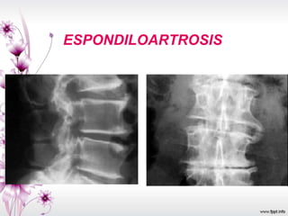 ESPONDILOARTROSIS
 