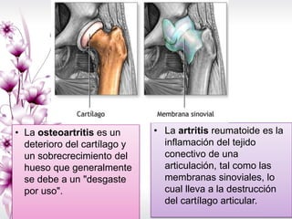 • La artritis reumatoide es la
inflamación del tejido
conectivo de una
articulación, tal como las
membranas sinoviales, lo
cual lleva a la destrucción
del cartílago articular.
• La osteoartritis es un
deterioro del cartílago y
un sobrecrecimiento del
hueso que generalmente
se debe a un "desgaste
por uso".
 