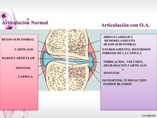 IRREGULARIDAD Y
REMODELAMIENTO
HUESO SUBCONDRAL
ENGROSAMIENTO, DISTORSION
FIBROSIS DE LA CAPSULA
FIBRILACION, VOLUMEN,
DEGRADACION CARTILAGO
SINOVITIS
OSTEOFITOS, TUMEFACCION
TEJIDOS BLANDOS
HUESO SUBCONDRAL
CARTILAGO
MARGEN ARTICULAR
SINOVIAL
CAPSULA
Articulación Normal Articulación con O.A.
 