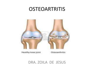 OSTEOARTRITIS




DRA. ZOILA DE JESUS
 