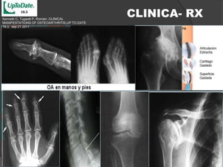 Kenneth C, Tugwell P, Romain ,CLINICAL
                                              CLINICA- RX
MANIFESTATIONS OF OSTEOARTHRITIS,UP TO DATE
19,3, sep 21 2011
 