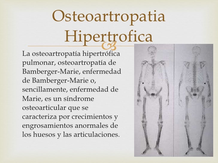 Osteoartropatía neúmica juan sachún copia