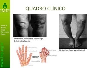 QUADRO CLÍNICO
AO Joelhos. Obesidade. Sobrecarga.
Déficit circulatório.
AO Joelhos. Genu-varo bilateral.
 
