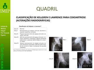 QUADRIL
CLASSIFICAÇÃO DE KELLGREN E LAWRENCE PARA COXOARTROSE
(ALTERAÇÕES RADIOGRÁFICAS)
 