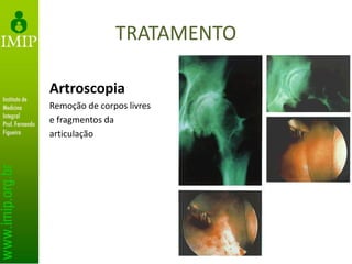 TRATAMENTO
Artroscopia
Remoção de corpos livres
e fragmentos da
articulação
 