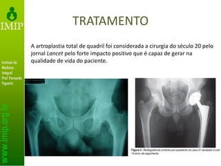 TRATAMENTO
A artroplastia total de quadril foi considerada a cirurgia do século 20 pelo
jornal Lancet pelo forte impacto positivo que é capaz de gerar na
qualidade de vida do paciente.
 