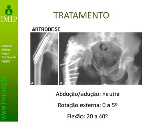 TRATAMENTO
Abdução/adução: neutra
Rotação externa: 0 a 5º
Flexão: 20 a 40º
ARTRODESE
 