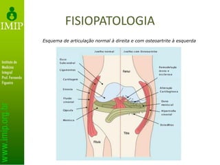 FISIOPATOLOGIA
Esquema de articulação normal à direita e com osteoartrite à esquerda
 