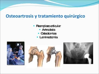 Osteoartrosis y tratamiento quirúrgico Reemplazo articular Artrodesis Osteotomias Laminectomía 