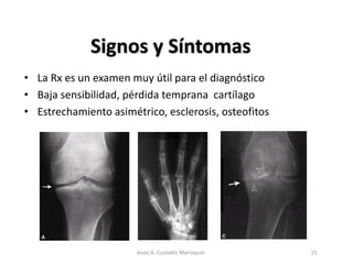 Signos y Síntomas
• La Rx es un examen muy útil para el diagnóstico
• Baja sensibilidad, pérdida temprana cartílago
• Estrechamiento asimétrico, esclerosis, osteofitos
21Jesús A. Custodio Marroquín
 