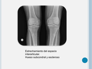 Estrechamiento del espacio
interarticular.
Hueso subcondral y escleroso
 