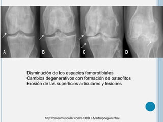 Disminución de los espacios femorotibiales
Cambios degenerativos con formación de osteofitos
Erosión de las superficies articulares y lesiones
http://osteomuscular.com/RODILLA/artropdegen.html
 