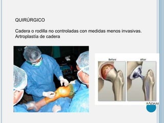 QUIRÚRGICO
Cadera o rodilla no controladas con medidas menos invasivas.
Artroplastía de cadera
 