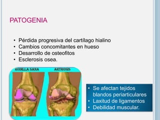 PATOGENIA
• Pérdida progresiva del cartílago hialino
• Cambios concomitantes en hueso
• Desarrollo de osteofitos
• Esclerosis osea.
• Se afectan tejidos
blandos periarticulares
• Laxitud de ligamentos
• Debilidad muscular.
 