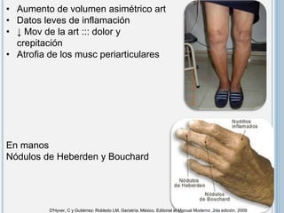• Aumento de volumen asimétrico art
• Datos leves de inflamación
• ↓ Mov de la art ::: dolor y
crepitación
• Atrofia de los musc periarticulares
En manos
Nódulos de Heberden y Bouchard
D'Hyver, C y Gutiérrez- Robledo LM. Geriatría. México. Editorial el Manual Moderno ,2da edición, 2009
 