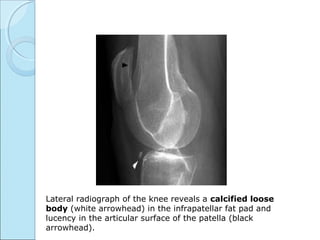 Lateral radiograph of the knee reveals a calcified loose
body (white arrowhead) in the infrapatellar fat pad and
lucency in the articular surface of the patella (black
arrowhead).
 