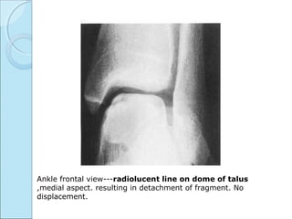 Ankle frontal view---radiolucent line on dome of talus
,medial aspect. resulting in detachment of fragment. No
displacement.
 