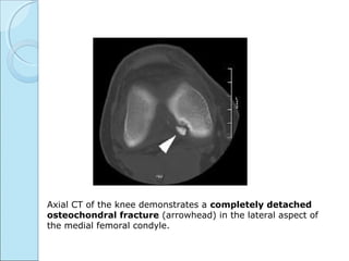 Axial CT of the knee demonstrates a completely detached
osteochondral fracture (arrowhead) in the lateral aspect of
the medial femoral condyle.
 
