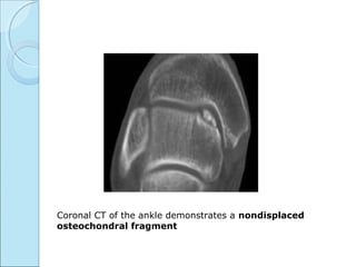 Coronal CT of the ankle demonstrates a nondisplaced
osteochondral fragment
 