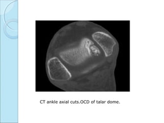 CT ankle axial cuts.OCD of talar dome.
 