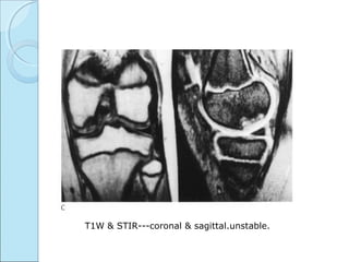 T1W & STIR---coronal & sagittal.unstable.
 