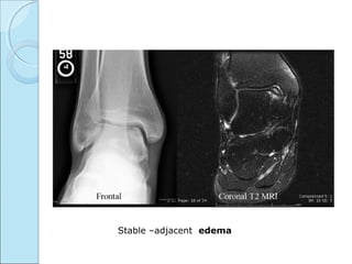 Stable –adjacent edema
 